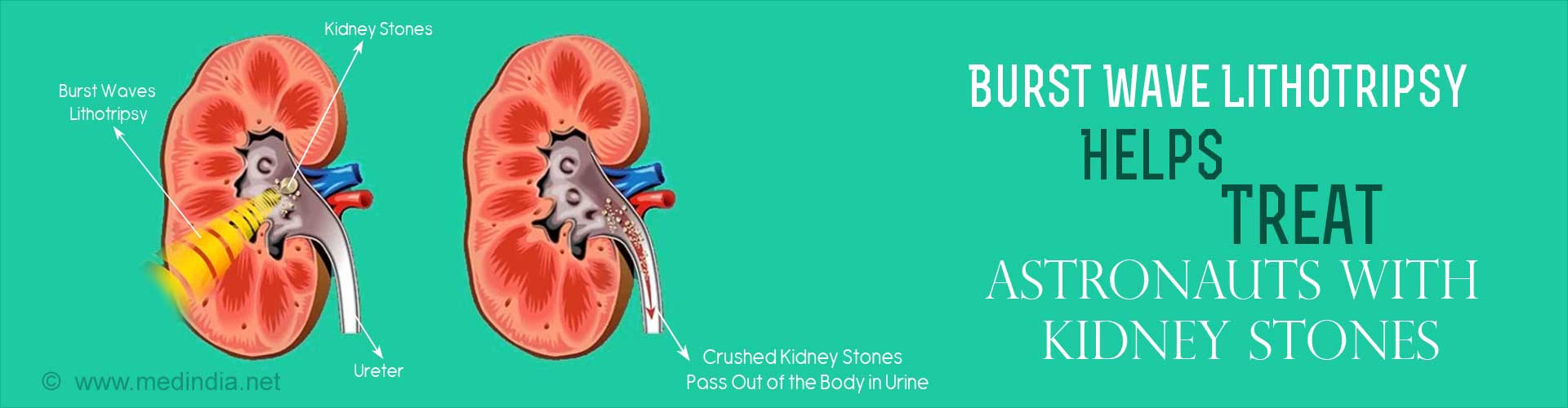 burst wave lithotripsy helps treat astronauts with kidney stones