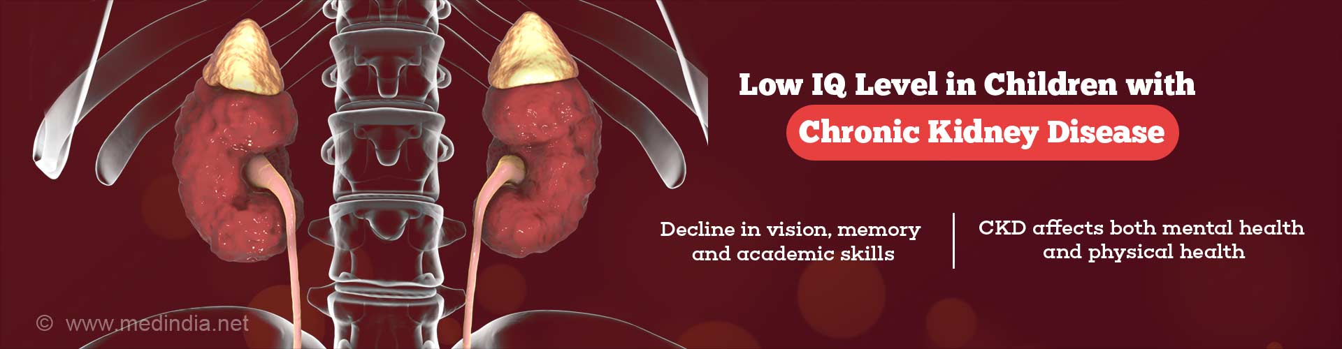 Low IQ level in children with chronic kidney disease
- decline in vision, memory and academic skills
- CKD affects both mental health and physical health