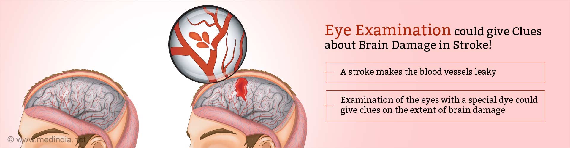 eye examination could give clues about brain damage in stroke
- a stroke make the blood vessels leaky
- examination of the eyes with a special dye could give clues on the extent of brain damage
