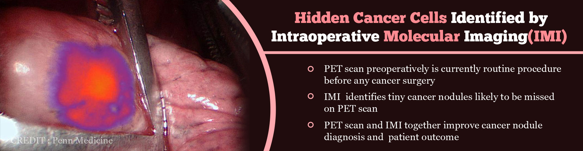 Hidden cancer cells identified by intraoperative molecular imaging (IMI)
- PET scan pre-operatively is currently routine procedure before any cancer surgery
- IMI identifies tiny cancer nodules likely to be missed on PET scan
- PET scan and IMI together improve cancer nodule diagnosis and patient outcome