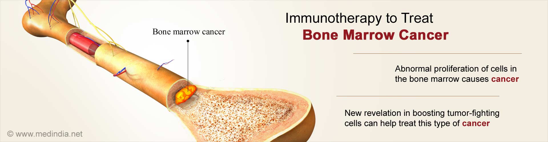 Immunotherapy to treat bone marrow cancer
- Abnormal proliferation of cells in the bone marrow causes cancer
- New revelation in boosting tumor-fighting cells can help treat this type of cancer