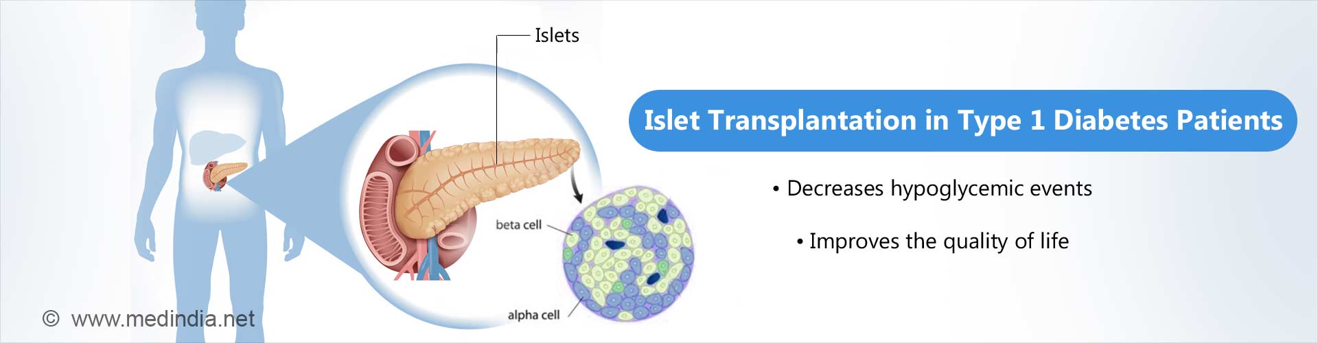 islet transplantation in type 1 diabetes patients
- decreases hypoglcemic events
- improves the quality of life