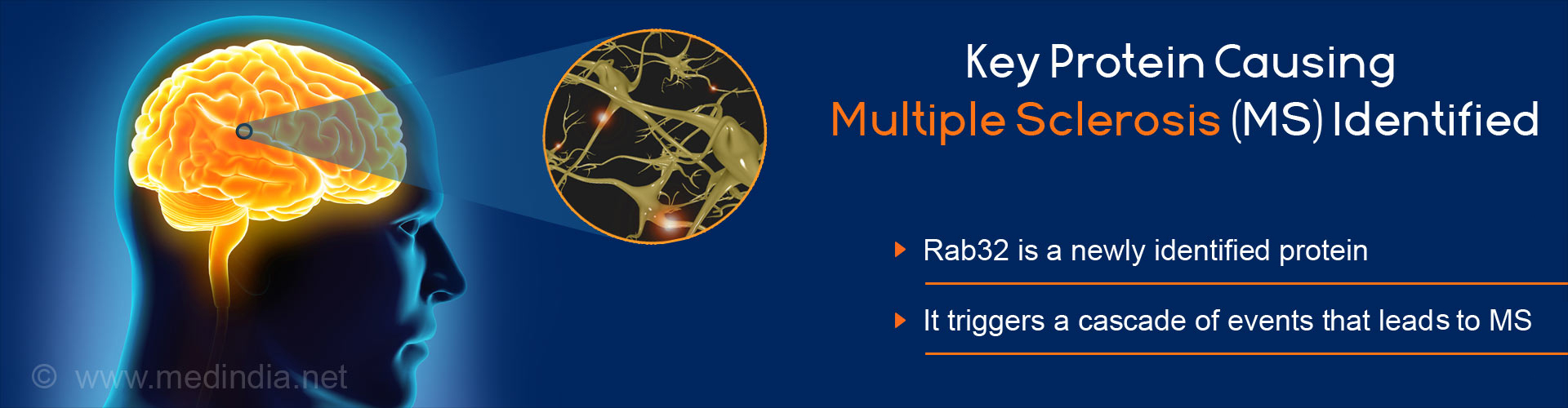 Key protein causing multiple sclerosis(ms) identified
- Rab32 is a newly identified protein
- It triggers a cascade of event that leads to ms