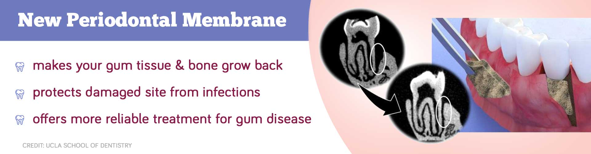 New periodontal membrane makes your gum tissue and bone grow back, protects damaged site from infections and offers more reliable treatment for gum disease.