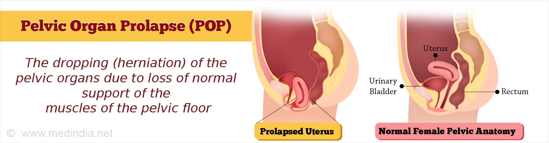 Pelvic Organ Prolapse (POP) - The dropping (herniation) of the pelvic organs due to loss of normal support of the muscles of the pelvic floor
