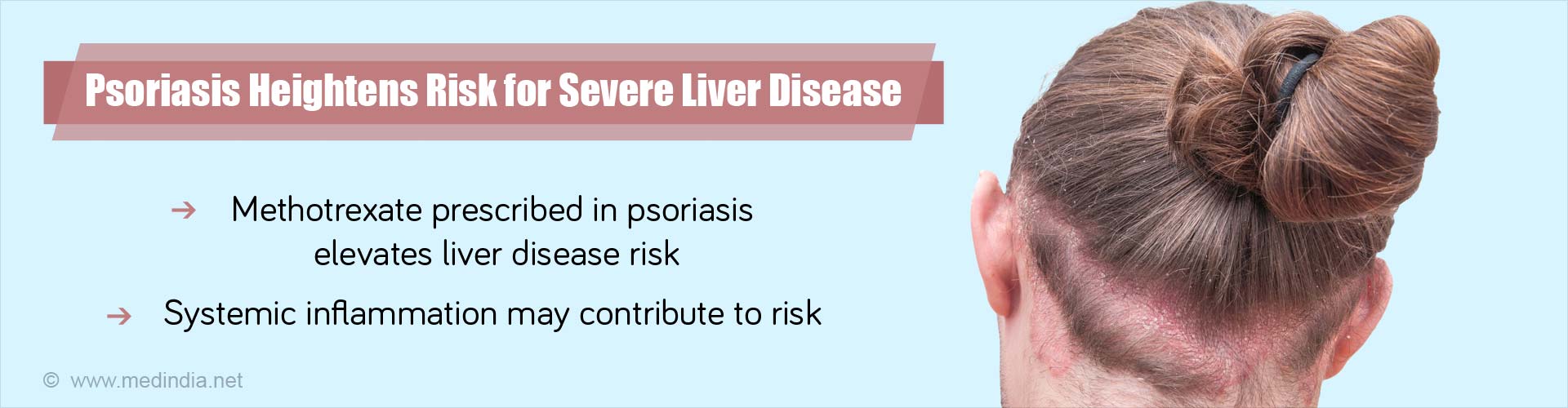Psoriasis heightens risk for severe liver disease
- methotrexate prescribed in psoriasis elevates liver disease risk
- systemic inflammation may contribute to risk