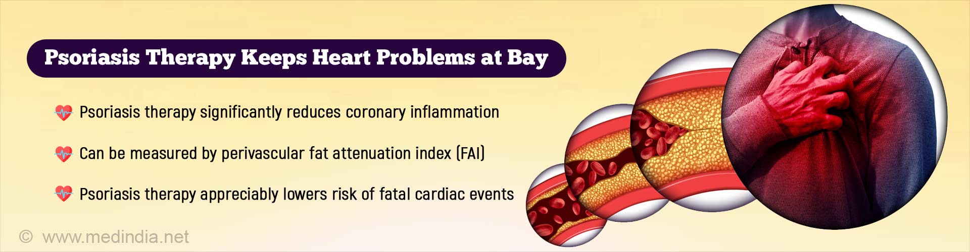Psoriasis therapy keeps heart problems at bay. Psoriasis therapy significantly reduces coronary inflammation. Can be measured by perivascular fat attenuation index (FAI). Psoriasis therapy appreciably lowers risk of fatal cardiac events.