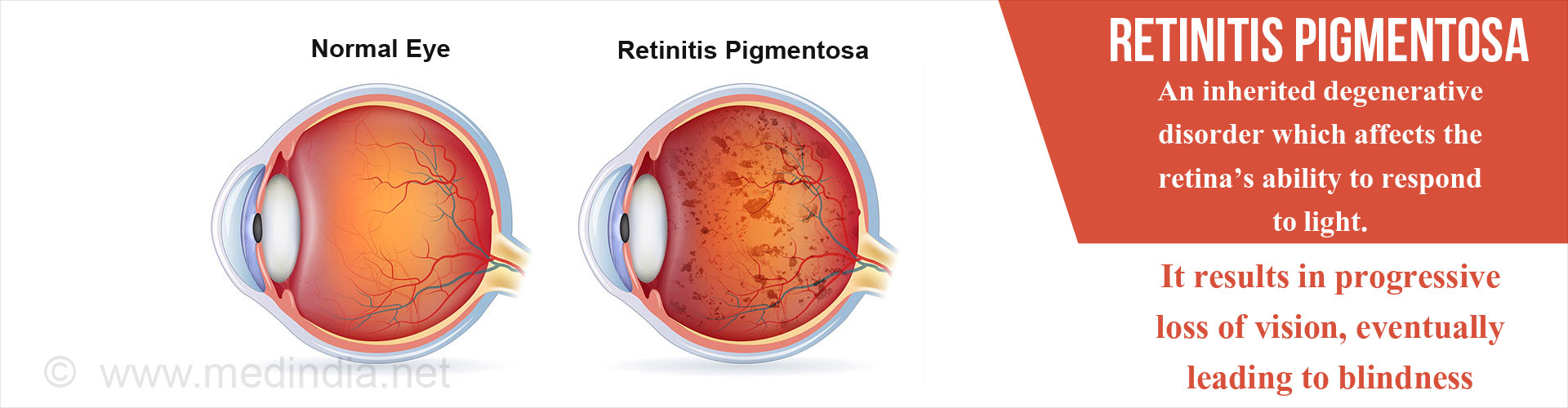 Retinitis Pigmentosa - an inherited degenerative disorder which affects the retina's ability to respond to light.

It results in progressive loss of vision, eventually leading to blindness

Noraml eye
Retinitis Pigmentosa
