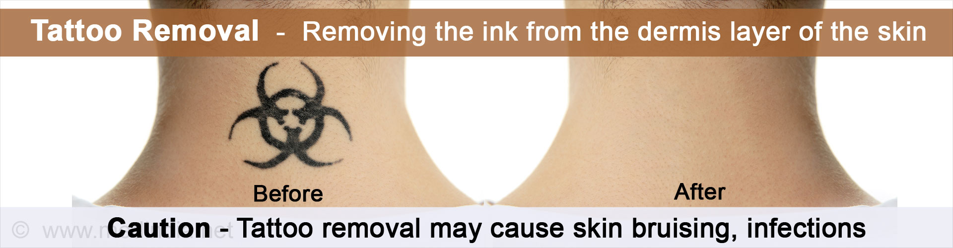 Tattoo Removal - Removing the ink from the dermis layer of the skin

Before After

Caution - Tattoo removal may cause skin bruising, infections