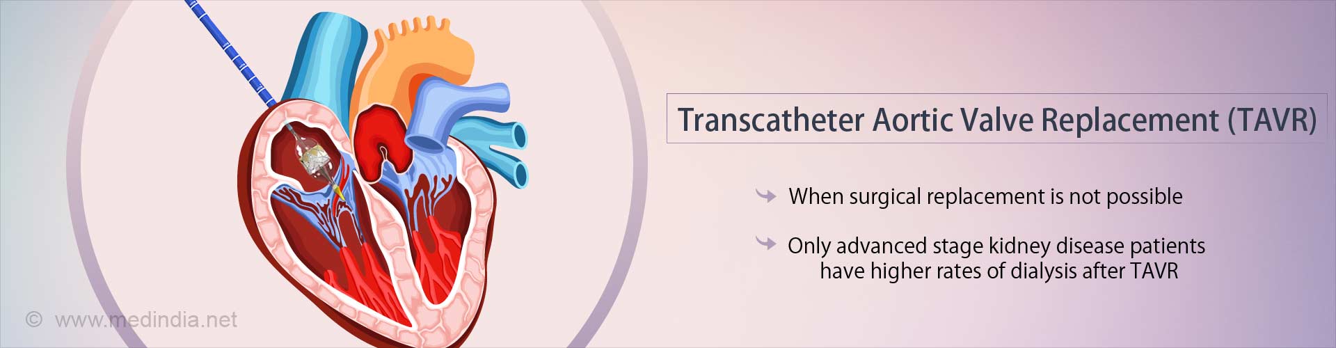 Health Tip on Risk of Dialysis in Kidney Patients After Transcatheter