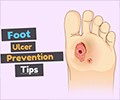 Foot Ulcer Prevention Tips