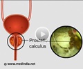 Prostatic Calculi