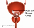 Pus From Ureteric Orifice
