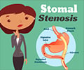 Stomal Stenosis