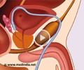 Urethral Diverticulum