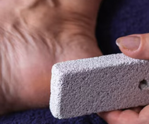 Say Goodbye to Cracked Heels with Simple Solutions