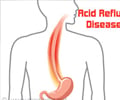 Acid Reflux Disease Acid Reflux Disease