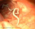 Intestinal Worm Treatment - Home Remedies