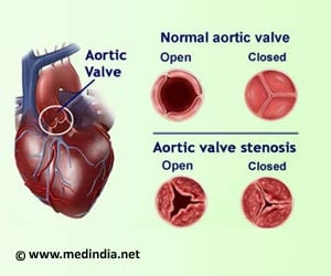 Aortic Valve Stenosis