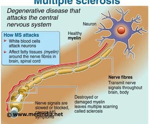 Multiple Sclerosis - New Drug