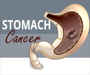 Stomach Cancer