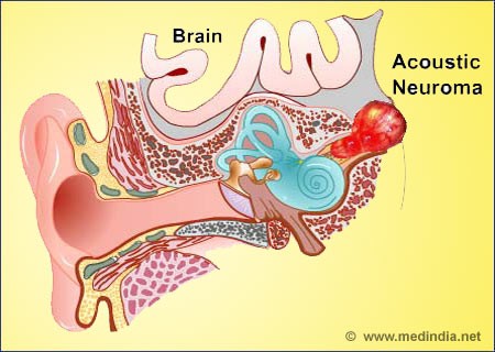 Acoustic Neuroma - Infographic