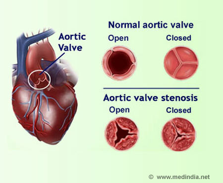 Aortic Valve Stenosis - Infographic