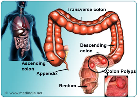Colon Polyps - Infographic
