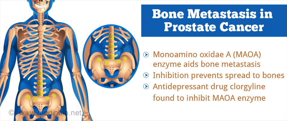 ‘old Drug Used For ‘new Method Of Preventing Bone Metastasis In