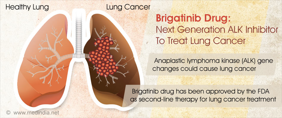 FDA Approves Brigatinib Drug For ALK-Positive Lung Cancer Treatment