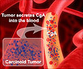 Carcinoid Tumors                                                                                                                                                                                        