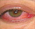 Corneal Ulcer - Causes - Symptoms - Diagnosis - Treatment - FAQs Corneal Ulcer - Causes - Symptoms - Diagnosis - Treatment - FAQs