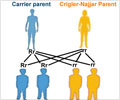 Crigler-Najjar Syndrome Crigler-Najjar Syndrome
