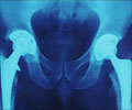 Hip Replacement- Osteoarthritis, Post Operative Complications