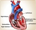 Infective Endocarditis-Causes-Symptoms-Diagnosis-Complications-Treatment
