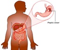 Peptic Ulcer Peptic Ulcer