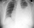 Pleural Effusion                                                                                                                                                                                        