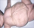 Prune Belly Syndrome                                                                                                                                                                                    