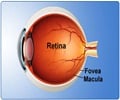 Retinal Detachment                                                                                                                                                                                      