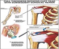 Rotator Cuff Injury - Causes - Symptoms - Diagnosis - Treatment - Prevention