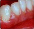 Swollen Gums