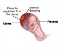 Placental Abruption | Abruptio Placentae - Causes, Clinical features, Diagnosis and Management