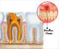 Tooth Abscess - Causes, Symptoms, Diagnosis, Treatments