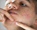 Acne - Causes Symptoms Diagnosis Treatment FAQs Videos Glossary Reference