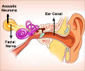 Auditory Tumor Auditory Tumor
