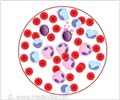 Acute Myeloid Leukemia-Causes-Symptoms-Diagnosis-Treatment-Prognosis-FAQs