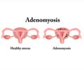 Adenomyosis | Bulky Uterus - Causes, Symptoms, Diagnosis, Treatment, Prevention and Prognosis Adenomyosis | Bulky Uterus - Causes, Symptoms, Diagnosis, Treatment, Prevention and Prognosis