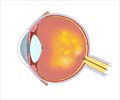 Age Related Macular Degeneration (AMD) - Causes, Symptoms, Diagnosis, Treatment & Prevention Age Related Macular Degeneration (AMD) - Causes, Symptoms, Diagnosis, Treatment & Prevention