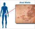 Anal Warts                                                                                                                                                                                              