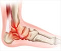 Ankle Pain - Symptom Evaluation Ankle Pain - Symptom Evaluation